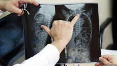 Ўзбекистонда умуртқа касалликларини даволаш учун янги қурилма ихтиро қилинди