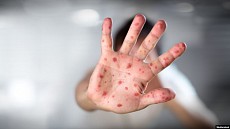 Соғлиқни сақлаш вазирлиги Самарқанд вилоятида қизамиқ эпидемиясининг ёйилиш сабабини маълум қилди